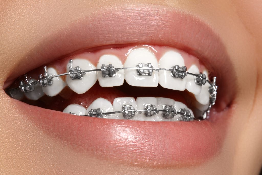 metal dental braces
