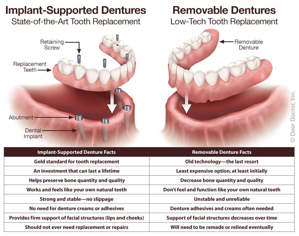 Implant Supported Dentures