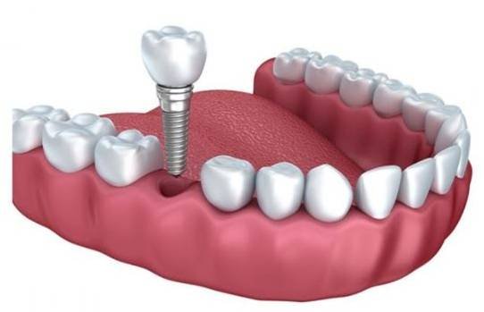 Dental Implant