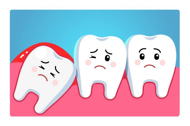 Painless Wisdom Tooth Extraction