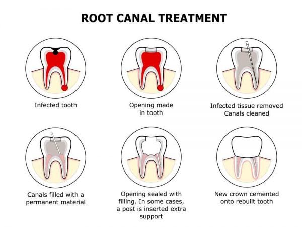 Painless Root Canal Treatment