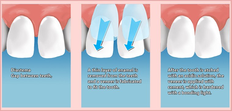 Dental Veneers