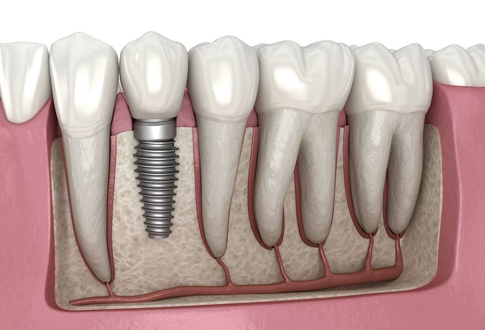 best dental implants in Gurgaon​​​,