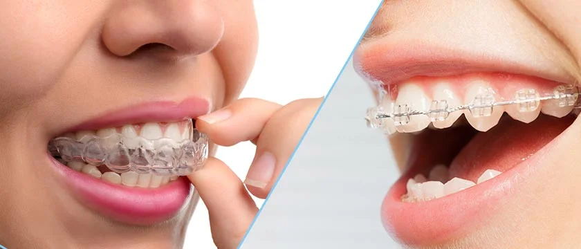 Toothsi vs Invisalign, How does Invisalign work
