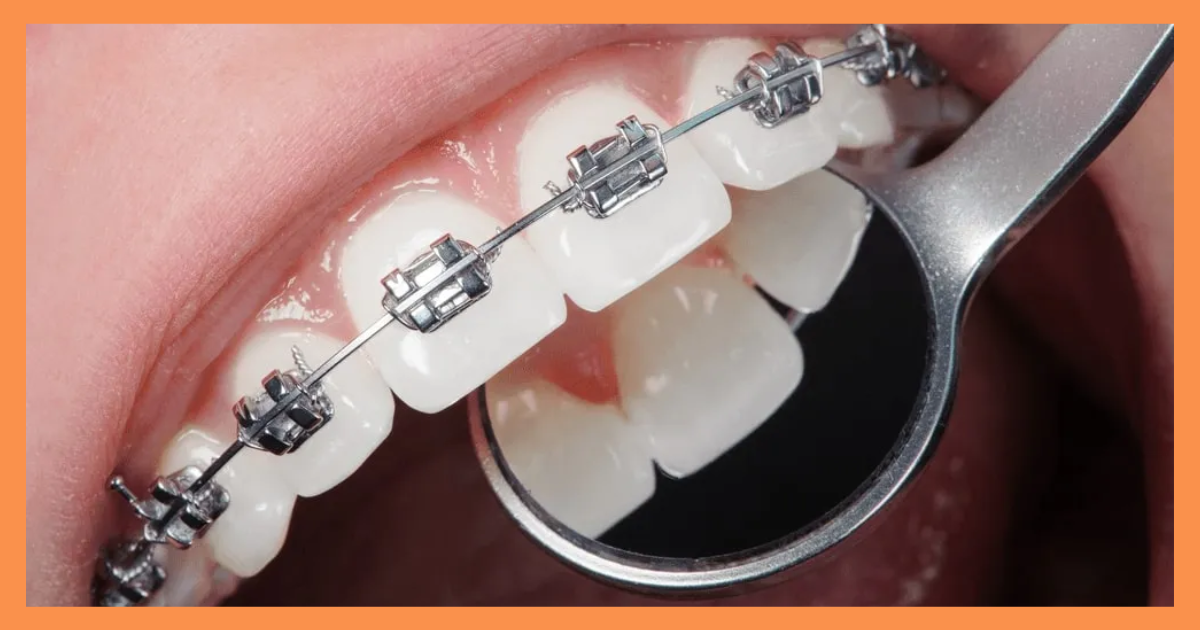 Braces treatment in Gurgaon