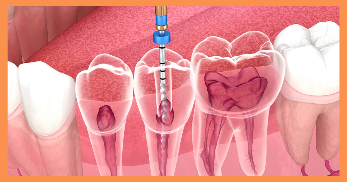 Endodontist in Gurgaon