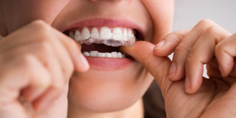 Aligners in Gurgaon