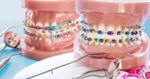 Braces Treatment