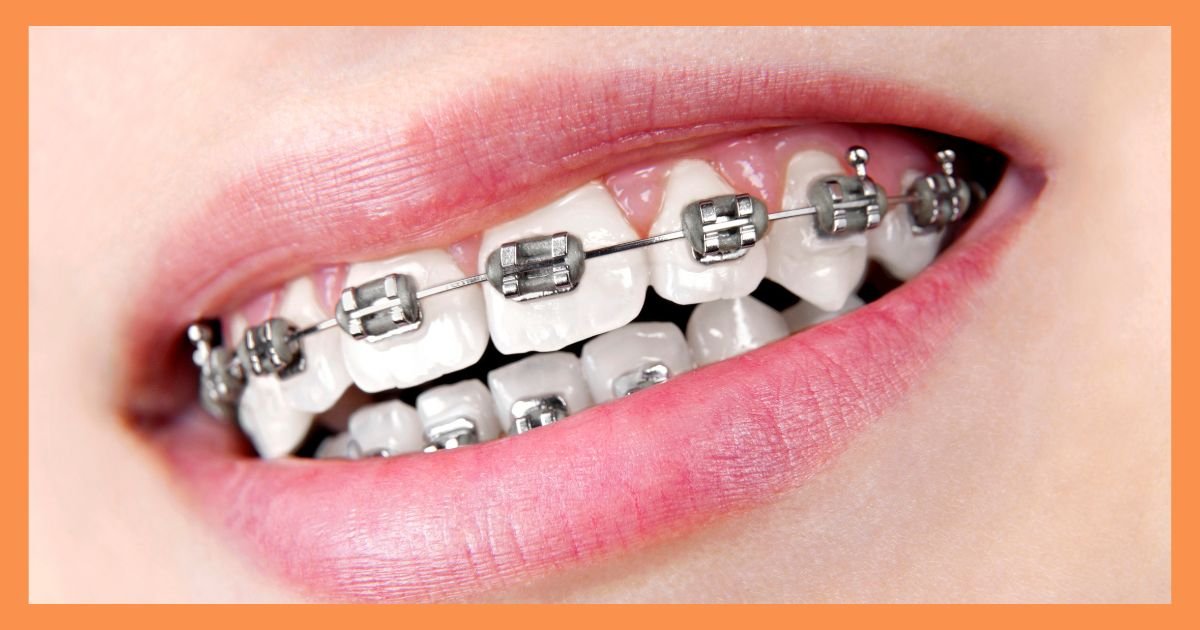 Braces Treatment in Gurgaon
