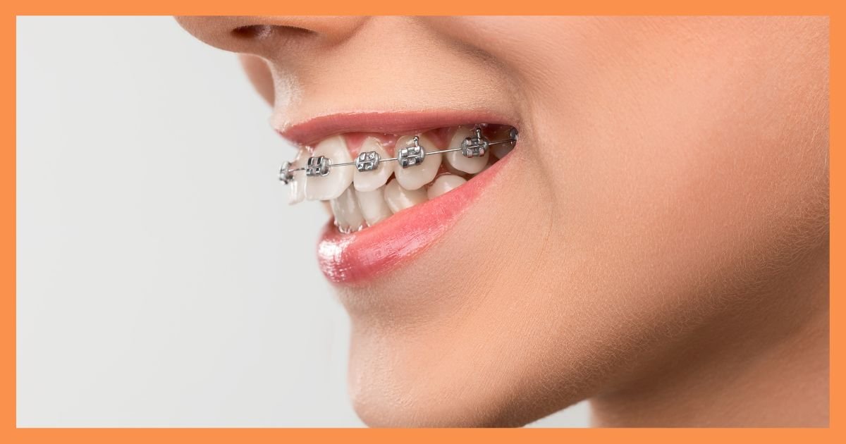 Braces Treatment