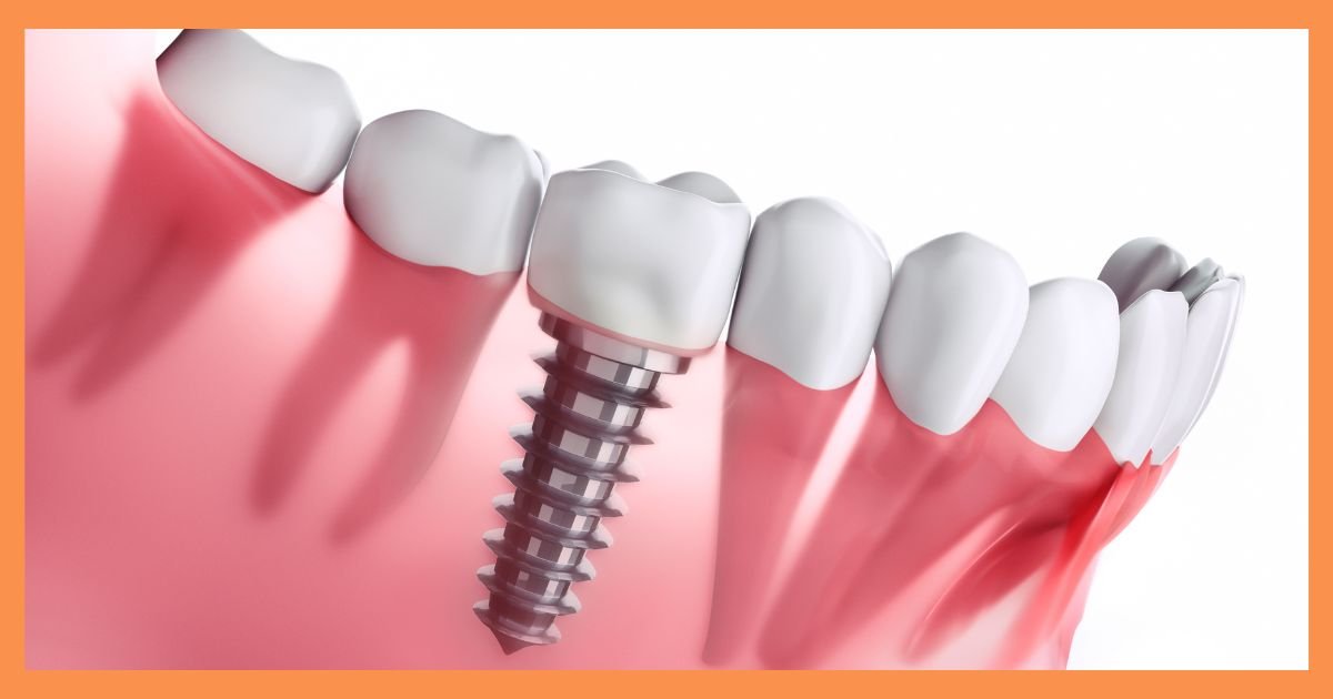 Dental implants in Gurgaon
