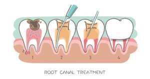 Root Canal Treatment in Gurgaon