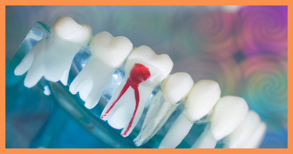 Root Canal Treatment