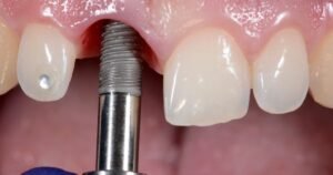 Dental Implantologist in Gurgaon