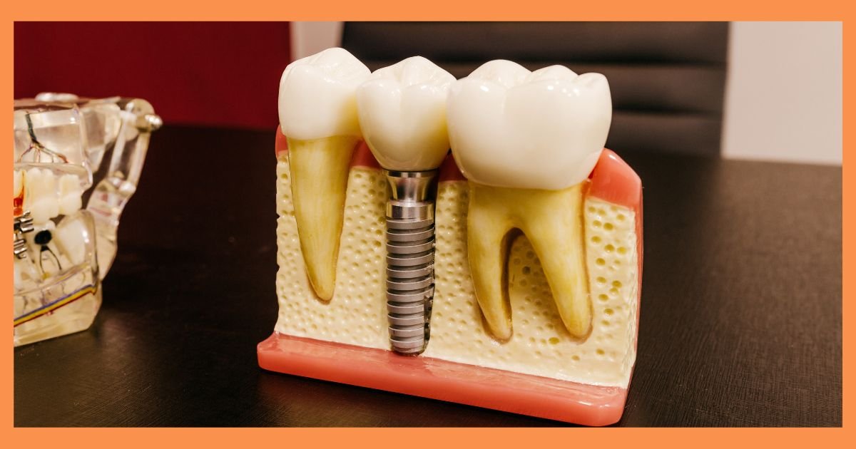 Dental Implantologist in Gurgaon