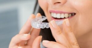 Aligners in Gurgaon