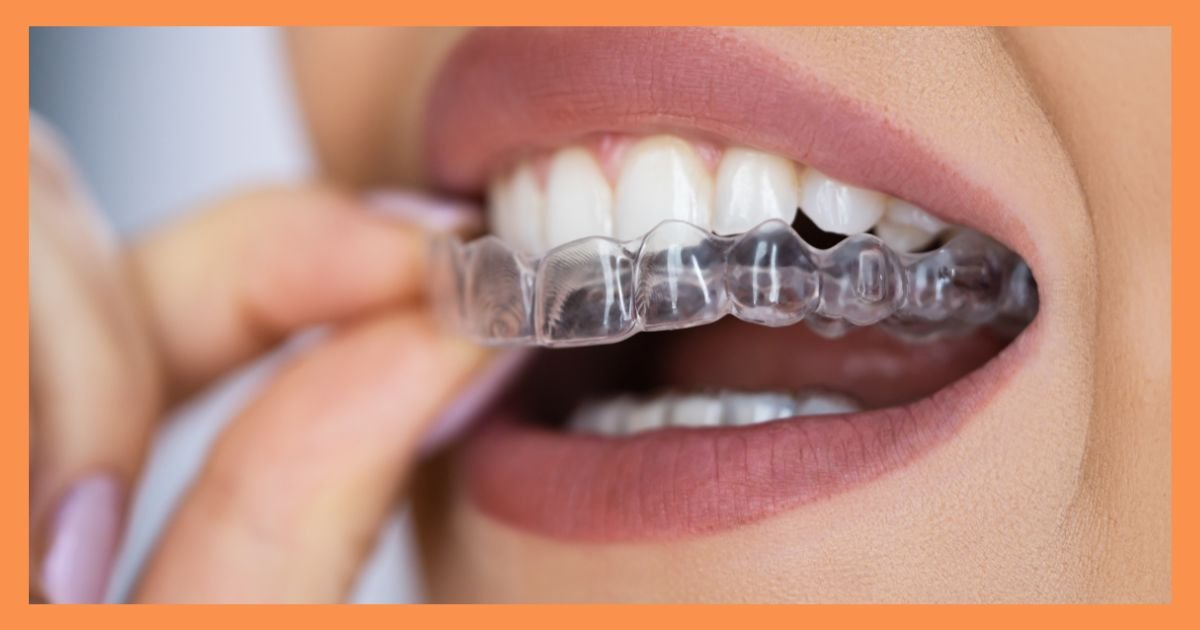 Aligners in Gurgaon