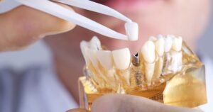 Dental implants in Gurgaon