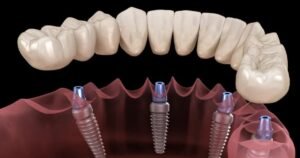 prosthodontist in gurgaon