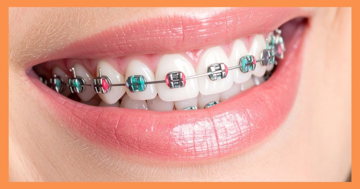 Orthodontics in Gurgaon