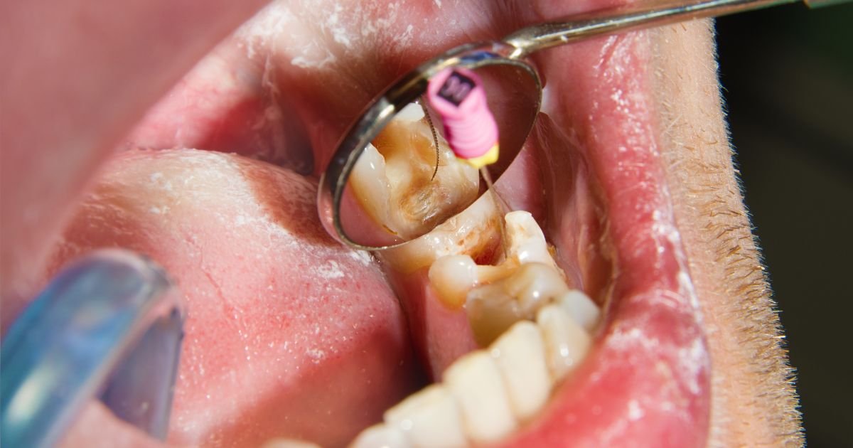 Root Canal Treatment