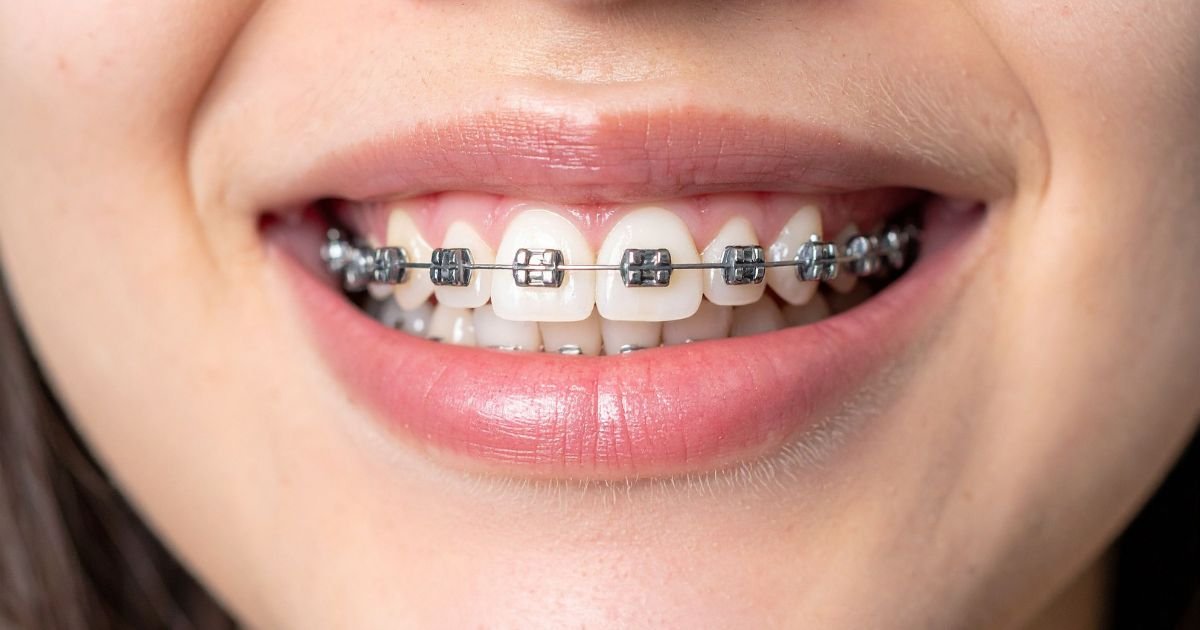 Braces Treatment in Gurgaon