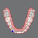aligner planning