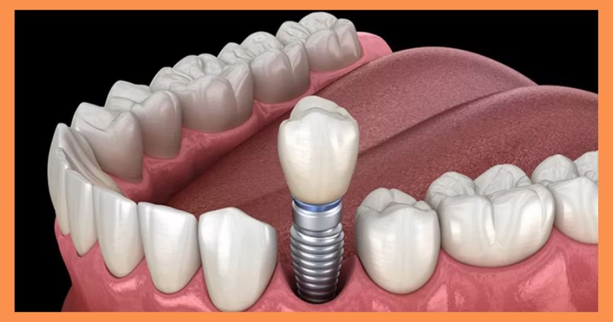 Implantologist in Gurgaon