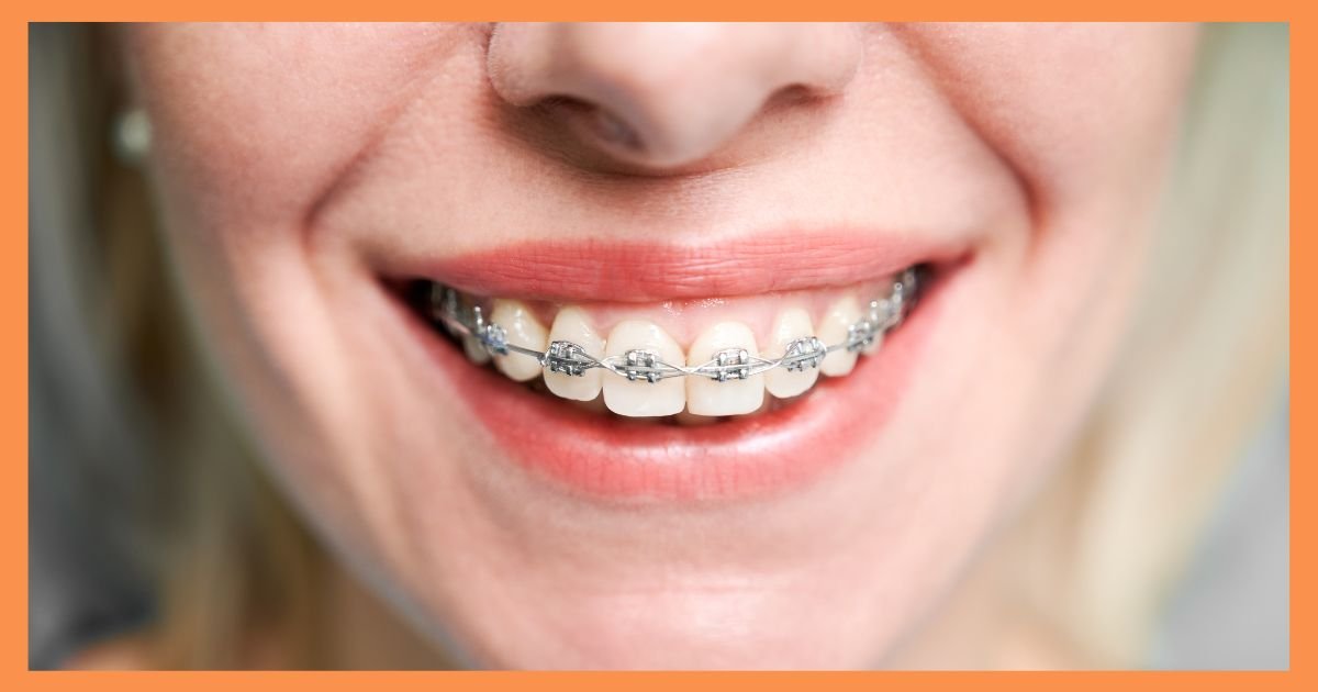 Braces Treatment in Gurgaon