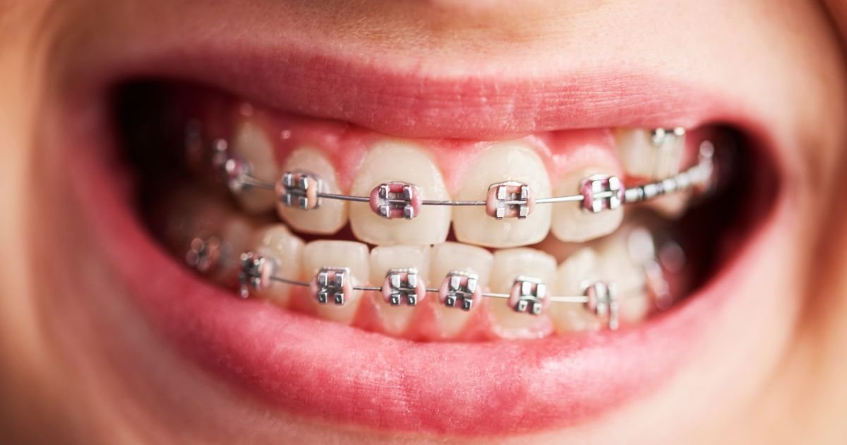 Braces Treatment in Gurgaon
