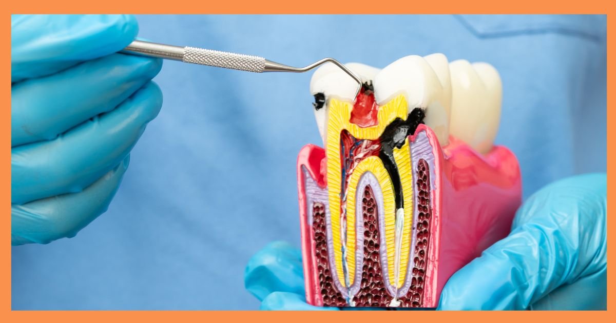 Root Canal Treatment in Gurgaon