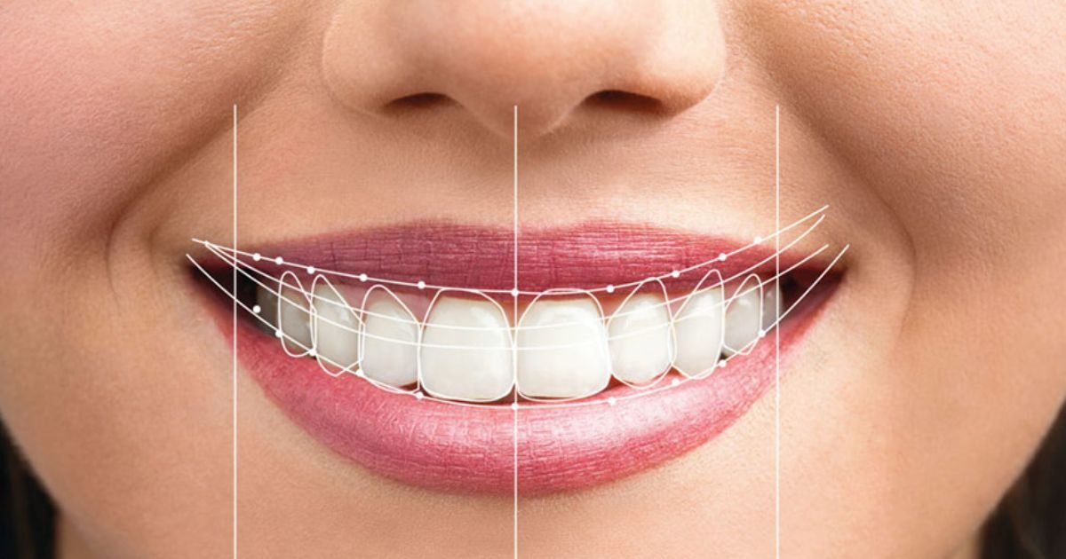 smile makeover in Gurgaon