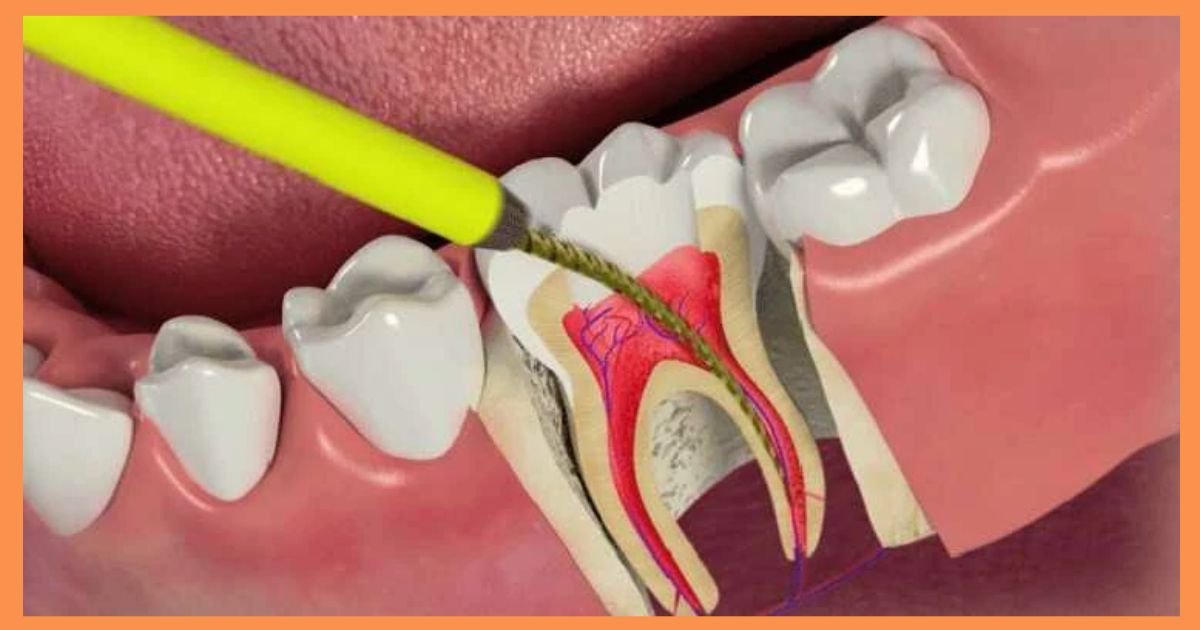 Endodontist in Gurgaon