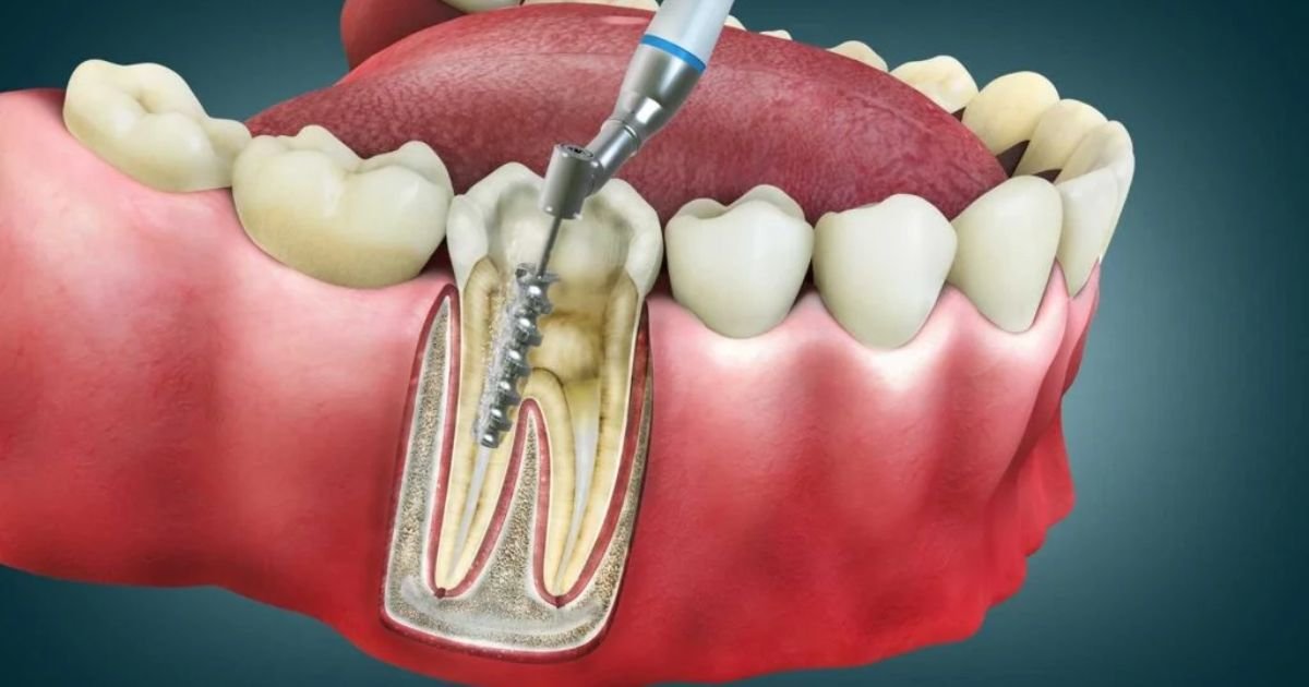 Endodontist in Gurgaon