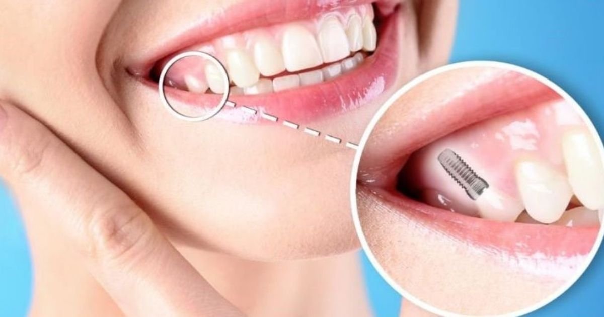 Implantologist in Gurgaon