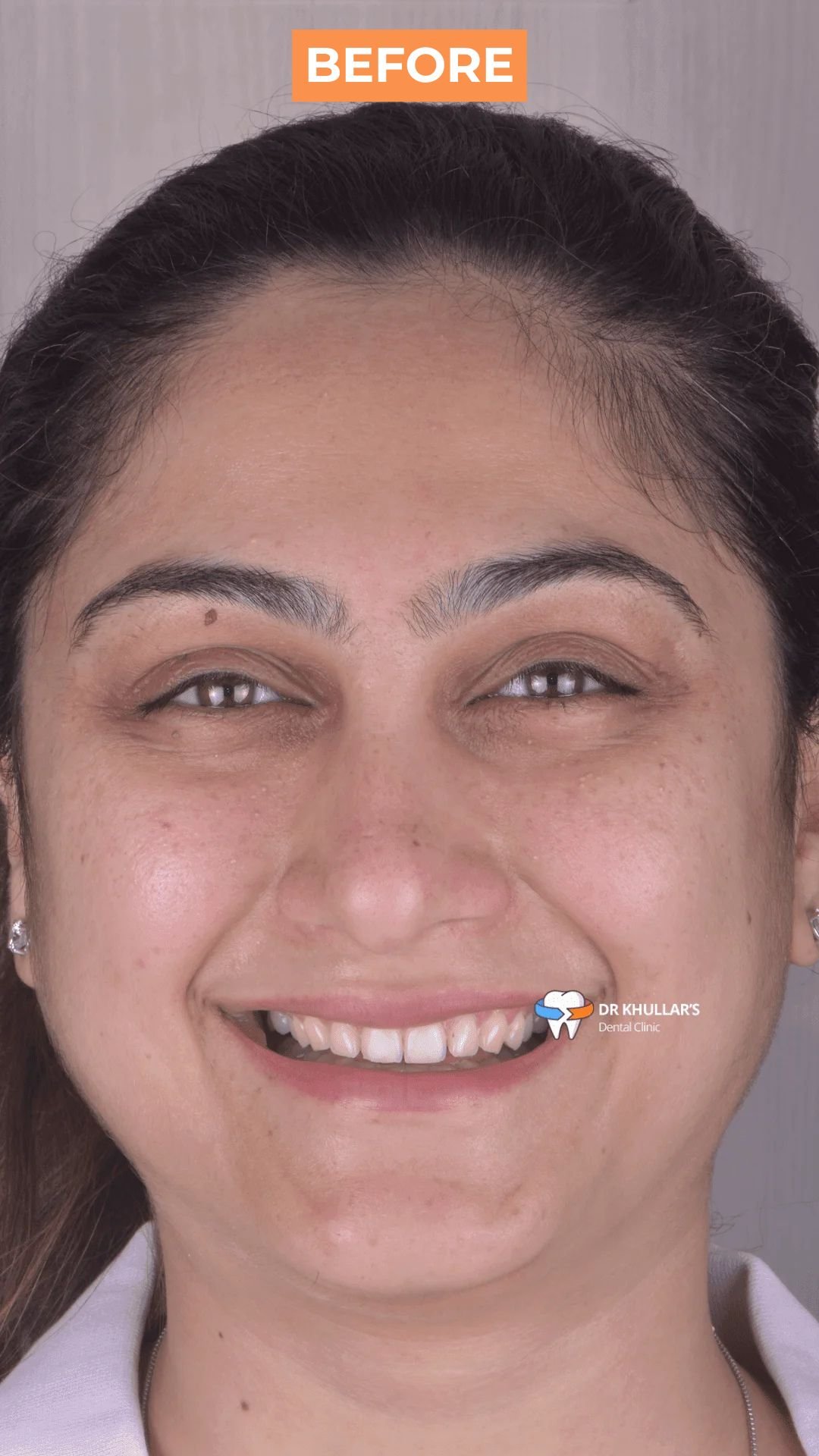 Before Dental Veneers