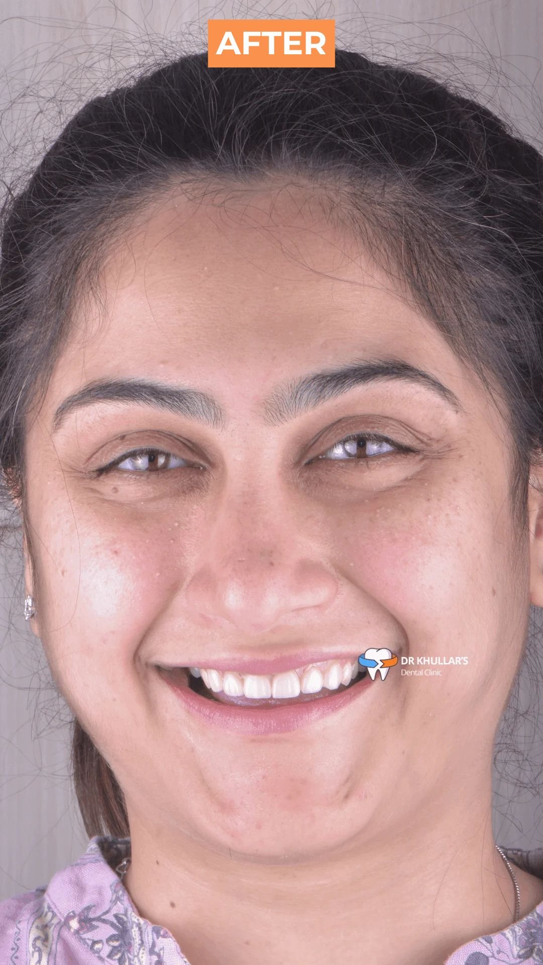 Results after veneers treatment Results after veneers treatment