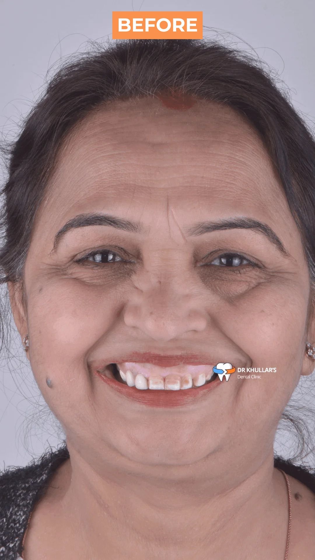 Before Full Mouth Rehabilitation