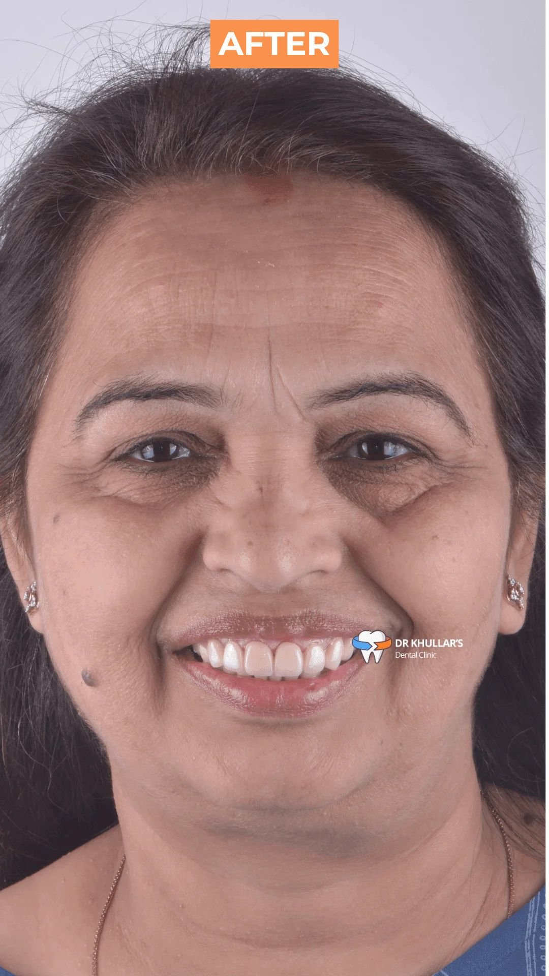 After Full Mouth Rehabilitation After Full Mouth Rehabilitation