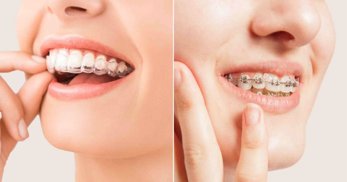 clear aligners