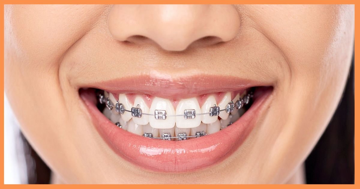 orthodontist in DLF Phase 5