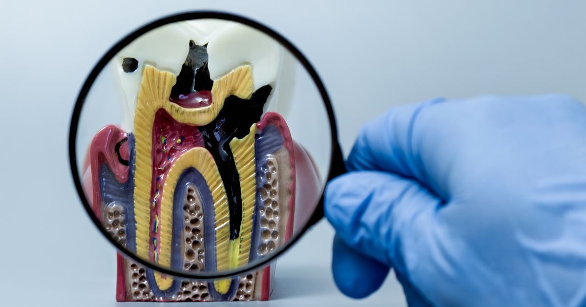 Root Canal Treatment in Gurgaon