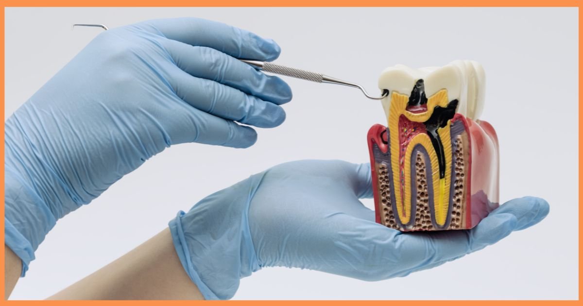 Root Canal Treatment in Gurgaon
