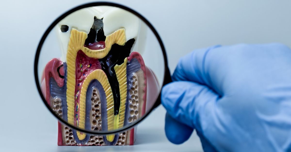 Root Canal Treatment in Gurgaon