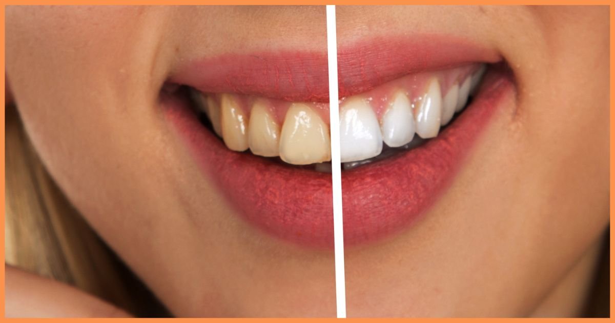 Teeth Whitening in Gurgaon