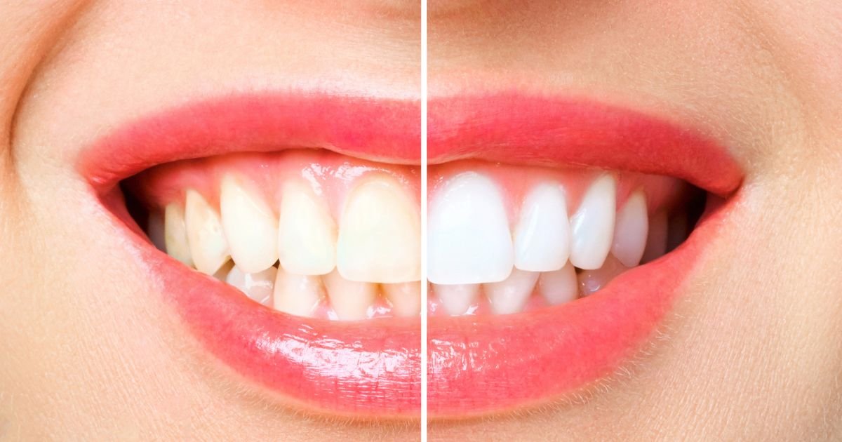 Teeth Whitening in Gurgaon