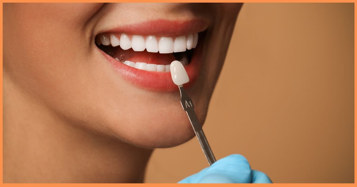 Veneers Treatment in Gurgao