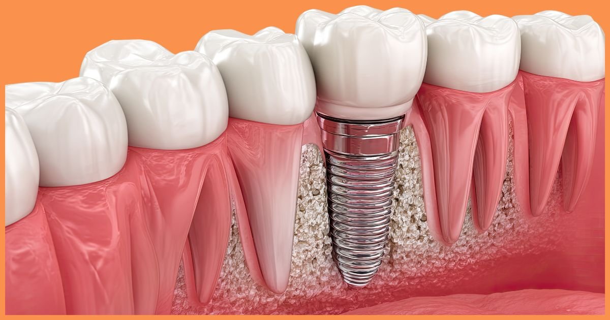 Dental implants in Gurgaon
