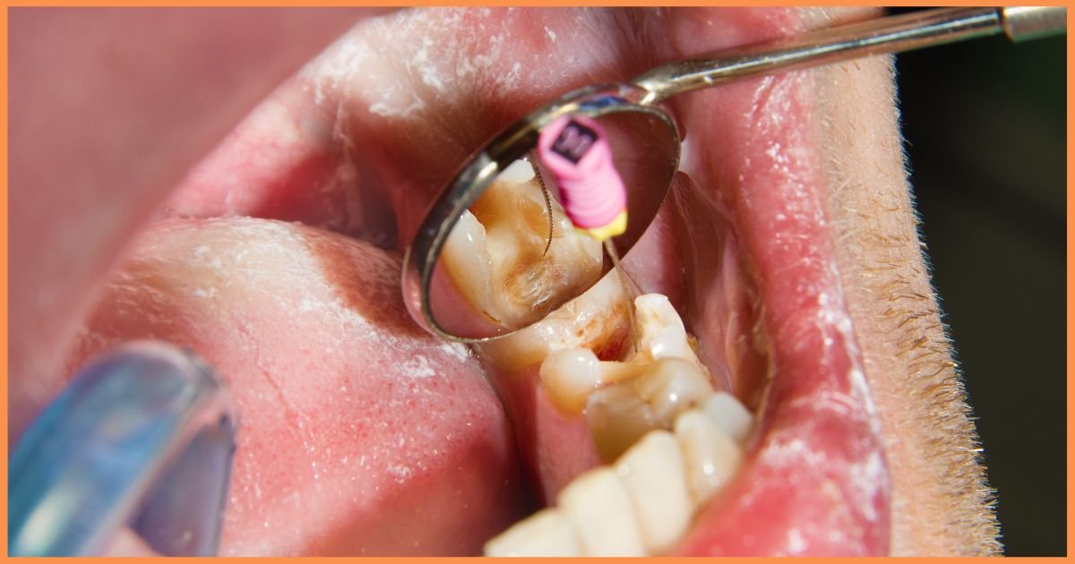 Painless Root Canal Treatment