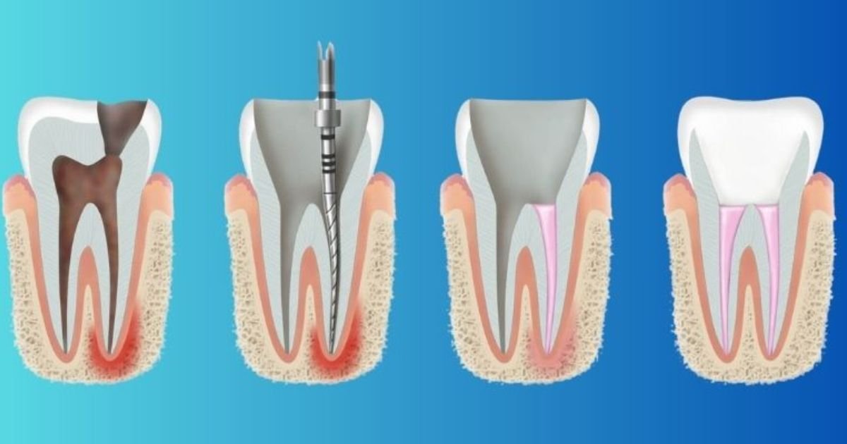 Root Canal Treatment in Gurgaon
